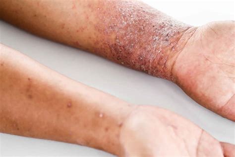What Is Atopic Dermatitis